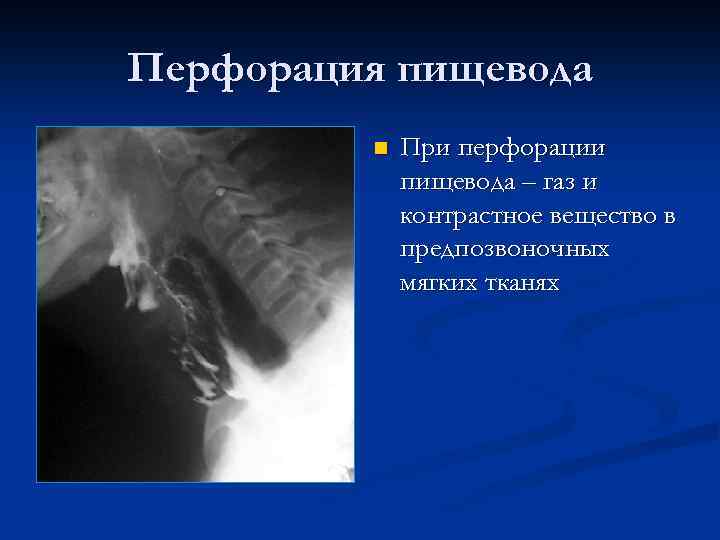 Перфорация пищевода n При перфорации пищевода – газ и контрастное вещество в предпозвоночных мягких
