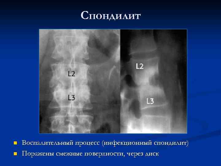 Спондилит n n Воспалительный процесс (инфекционный спондилит) Поражены смежные поверхности, через диск 