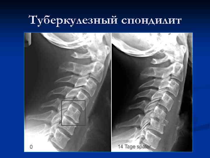 Туберкулезный спондилит 