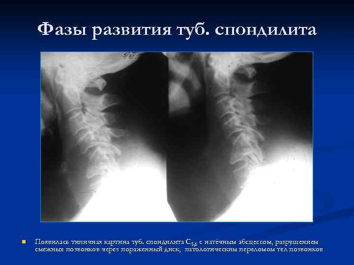 Фазы развития туб. спондилита n Появилась типичная картина туб. спондилита С 5, 6 с