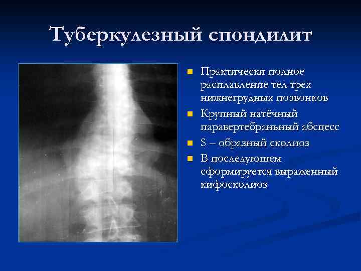 Туберкулезный спондилит n n Практически полное расплавление тел трех нижнегрудных позвонков Крупный натёчный паравертебраньный