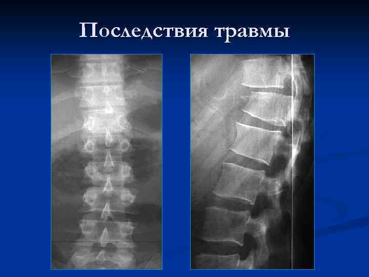 Последствия травмы 