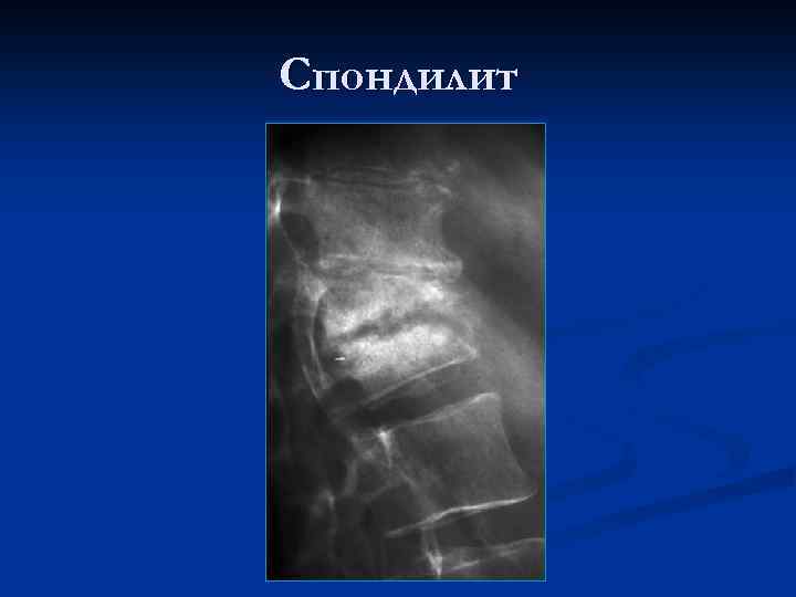 Спондилит 