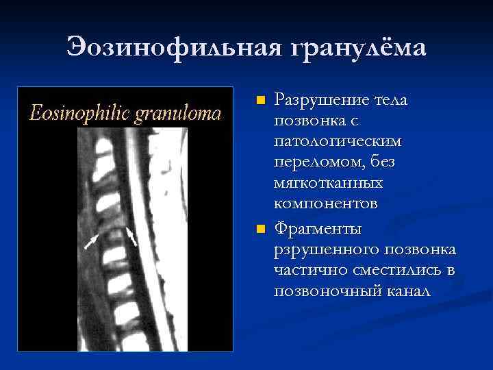 Эозинофильная гранулёма n n Разрушение тела позвонка с патологическим переломом, без мягкотканных компонентов Фрагменты