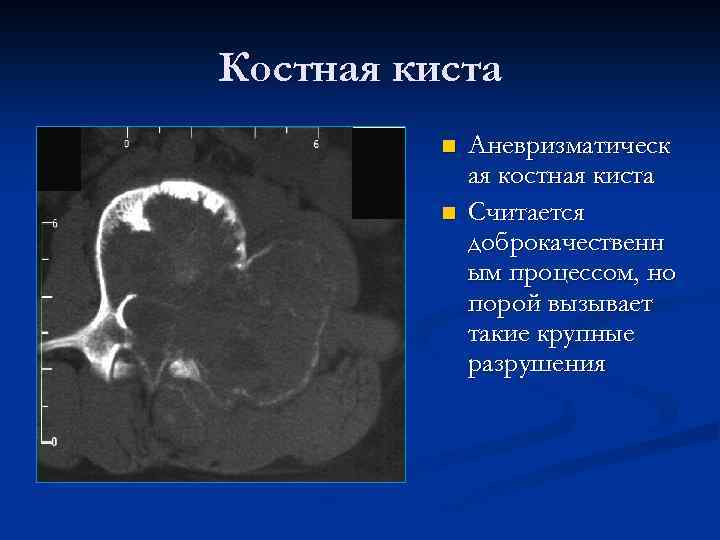 Костная киста n n Аневризматическ ая костная киста Считается доброкачественн ым процессом, но порой