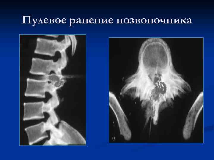 Пулевое ранение позвоночника 