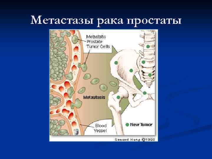 Метастазы рака простаты 