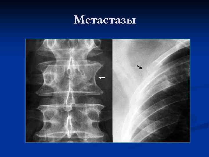 Метастазы 