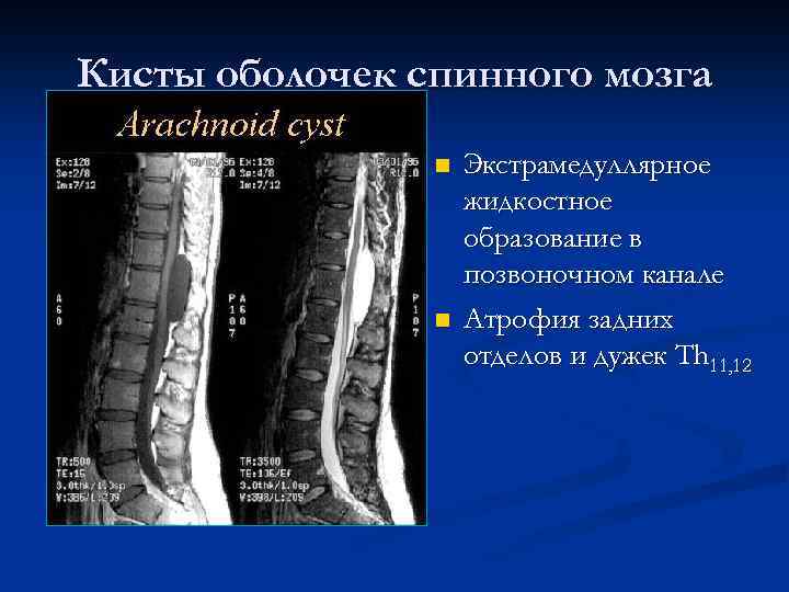 Кисты оболочек спинного мозга n n Экстрамедуллярное жидкостное образование в позвоночном канале Атрофия задних