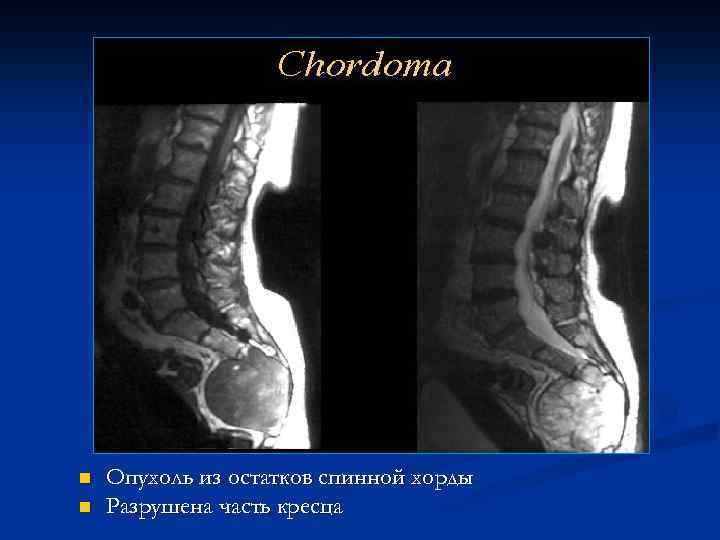 n n Опухоль из остатков спинной хорды Разрушена часть кресца 