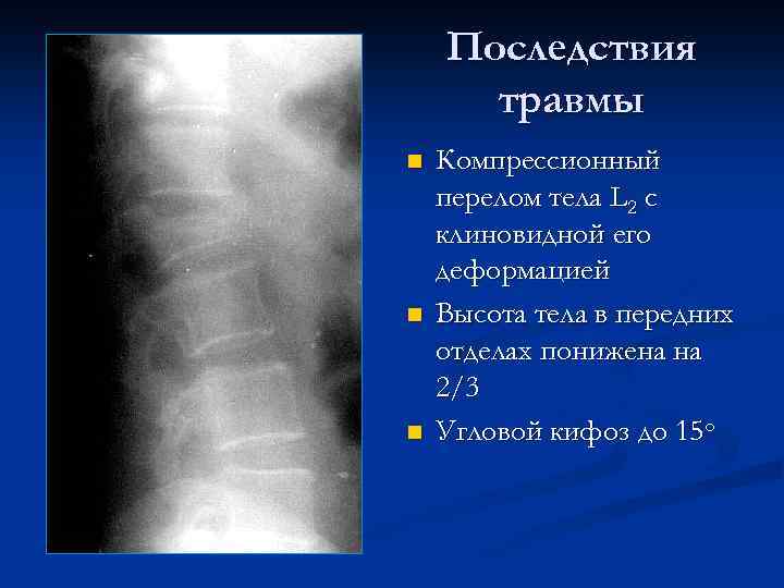 Последствия травмы n n n Компрессионный перелом тела L 2 с клиновидной его деформацией