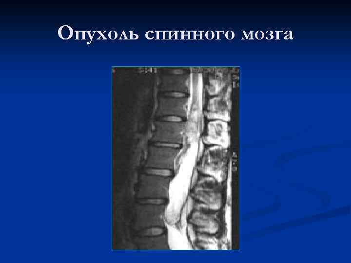 Опухоль спинного мозга 