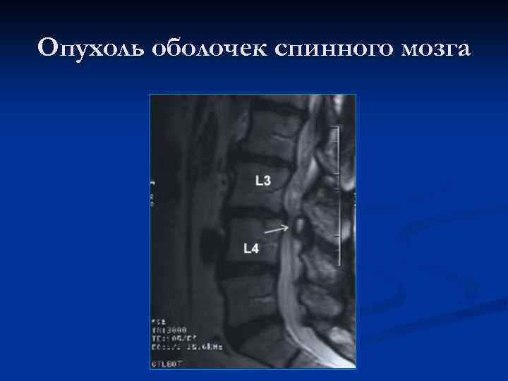 Опухоль оболочек спинного мозга 