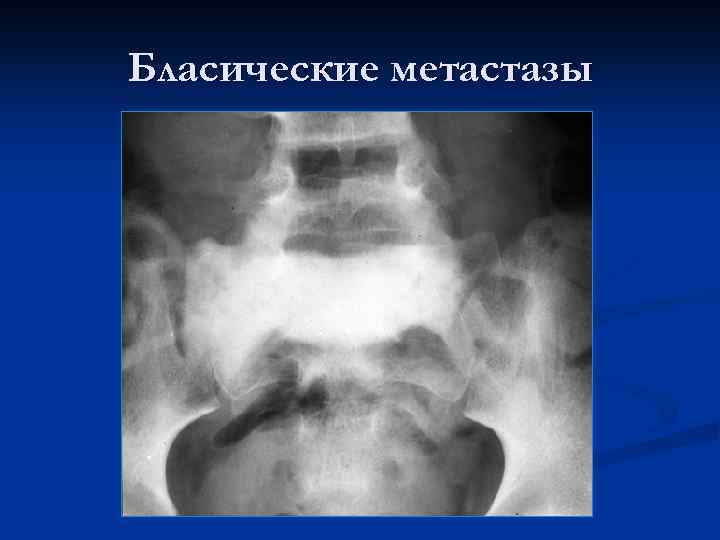 Бласические метастазы 