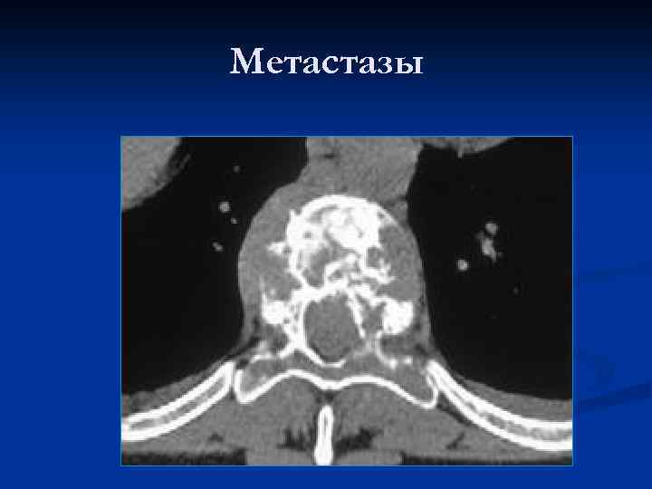 Метастазы 