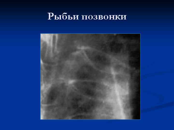 Рыбьи позвонки 