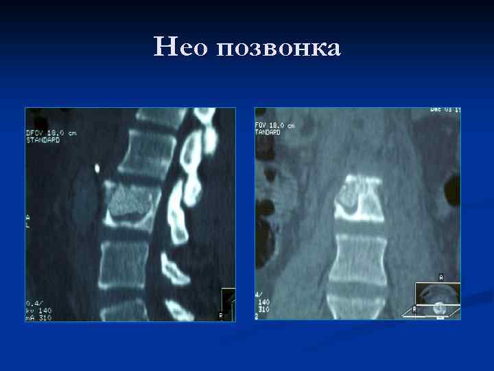 Нео позвонка 