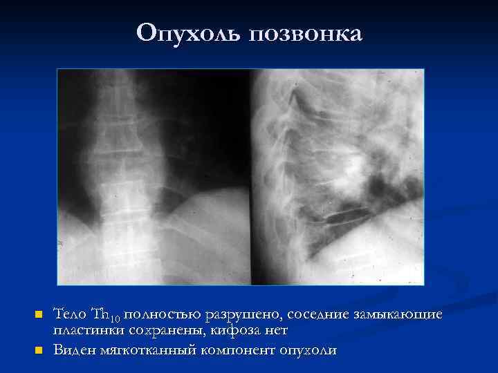 Опухоль позвонка n n Тело Th 10 полностью разрушено, соседние замыкающие пластинки сохранены, кифоза
