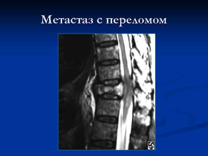 Метастаз с переломом 