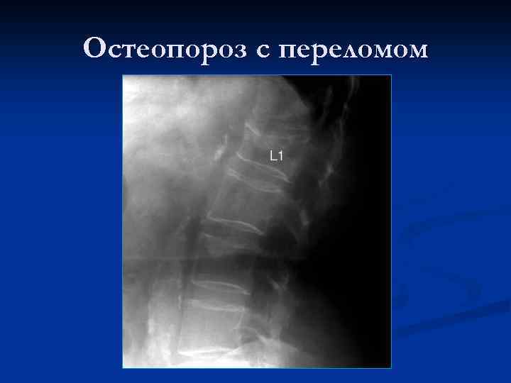 Остеопороз с переломом 