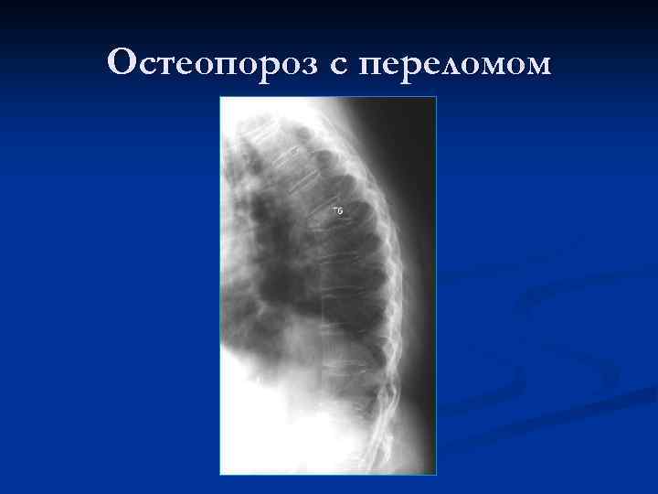 Остеопороз с переломом 