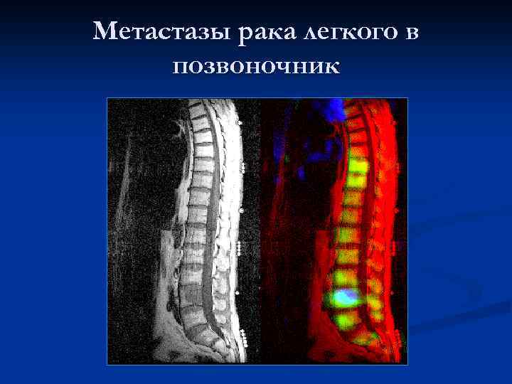 Метастазы рака легкого в позвоночник 