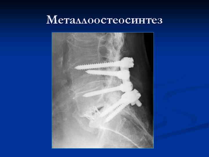 Металлоостеосинтез 
