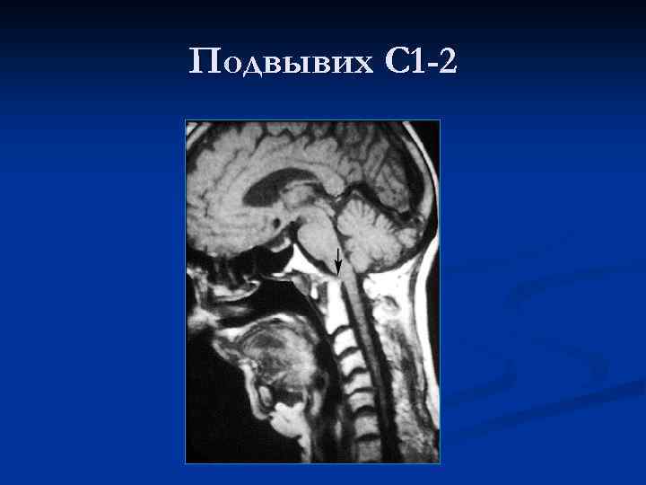 Подвывих С 1 -2 