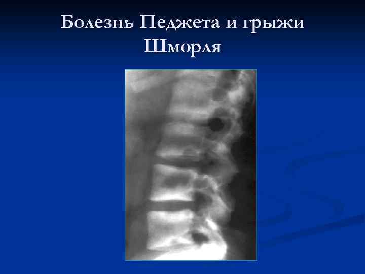 Болезнь Педжета и грыжи Шморля 