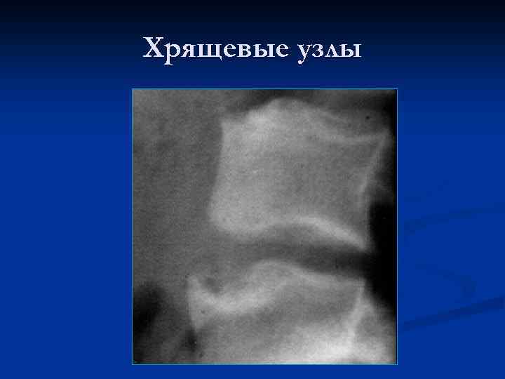 Хрящевые узлы 