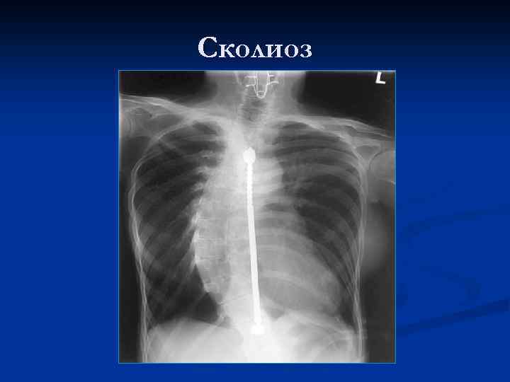 Сколиоз 