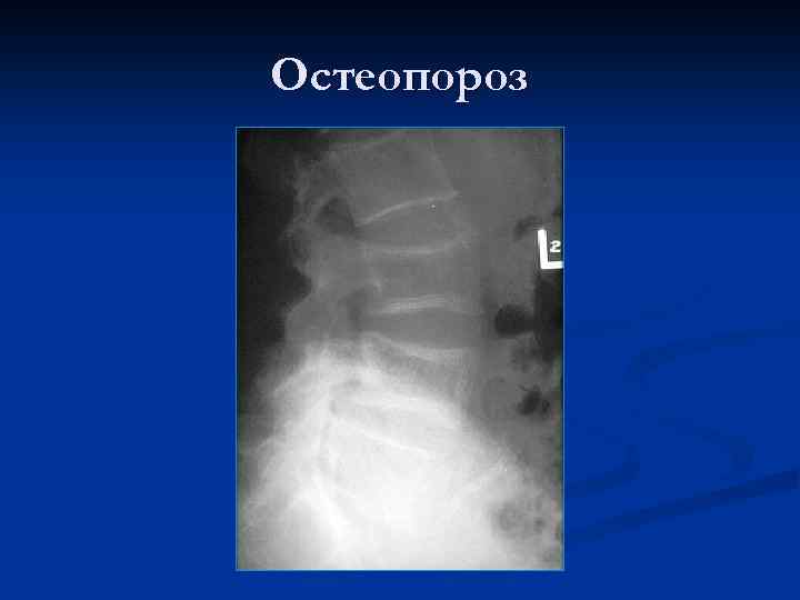 Остеопороз 