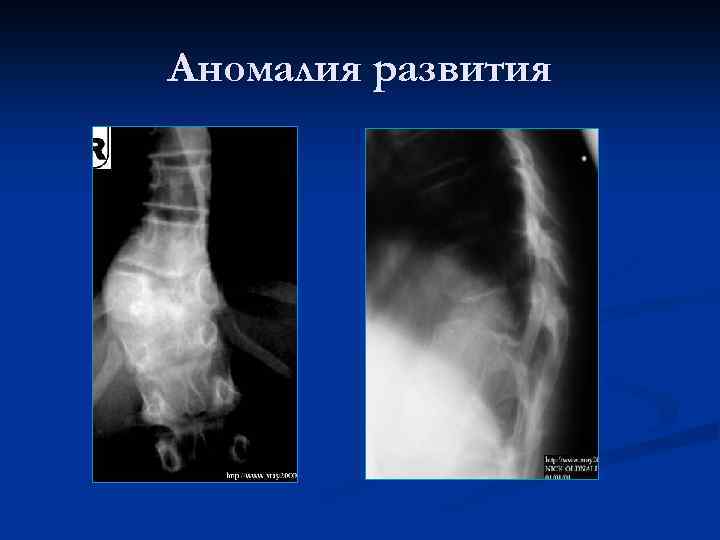 Аномалия развития 