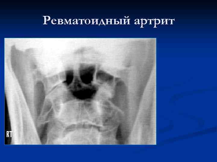 Ревматоидный артрит 