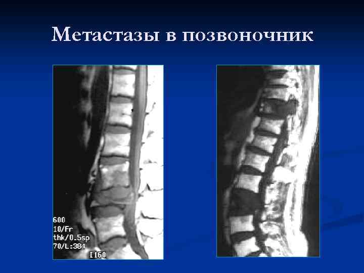 Метастазы в позвоночник 