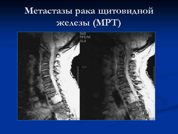 Метастазы рака щитовидной железы (МРТ) 