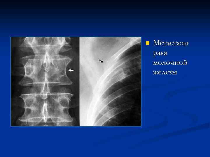 n Метастазы рака молочной железы 
