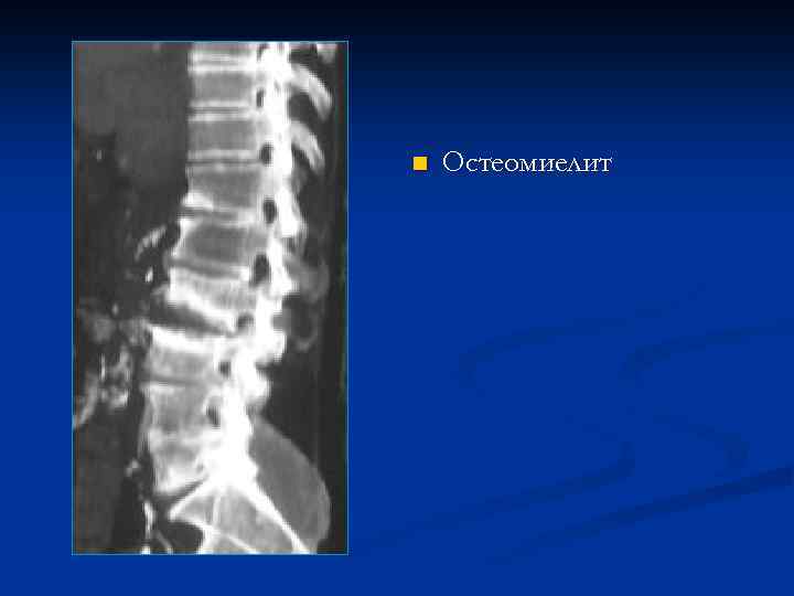 n Остеомиелит 