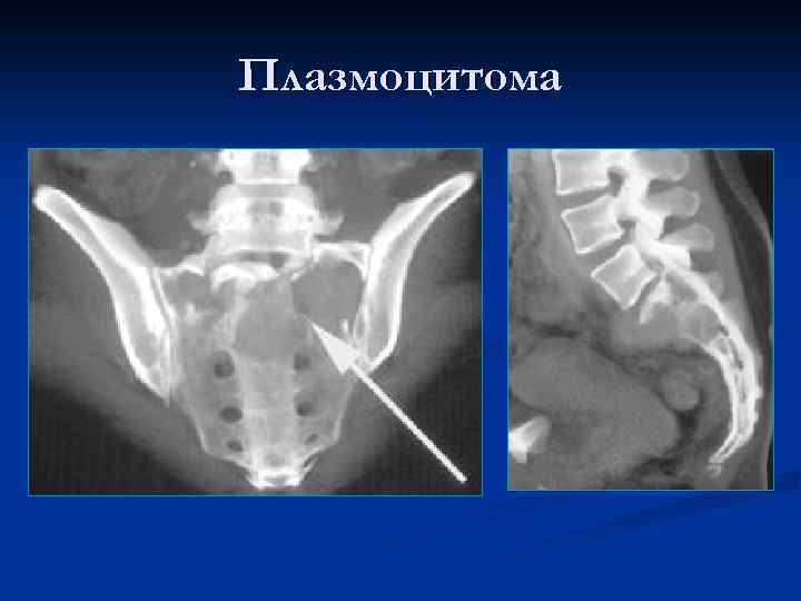 Плазмоцитома 