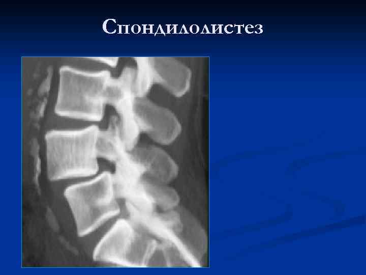 Спондилолистез 