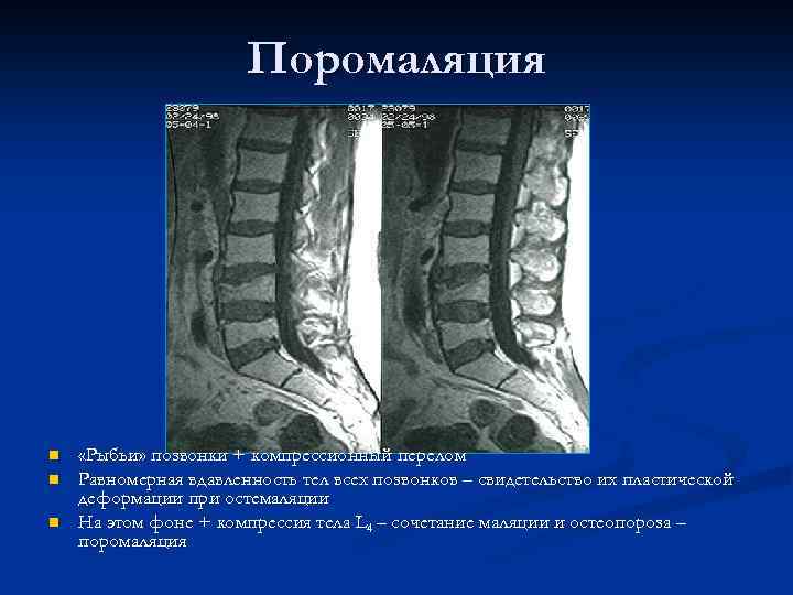 Поромаляция n n n «Рыбьи» позвонки + компрессионный перелом Равномерная вдавленность тел всех позвонков