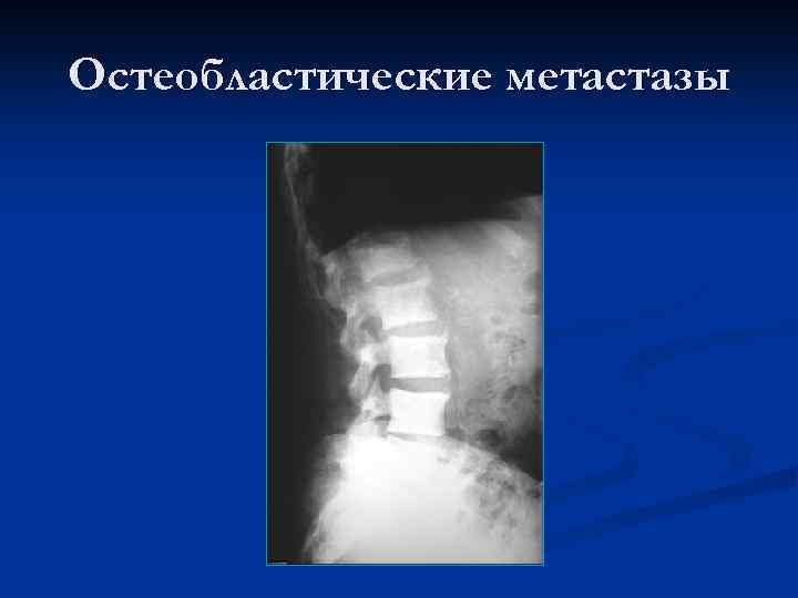 Остеобластические метастазы 