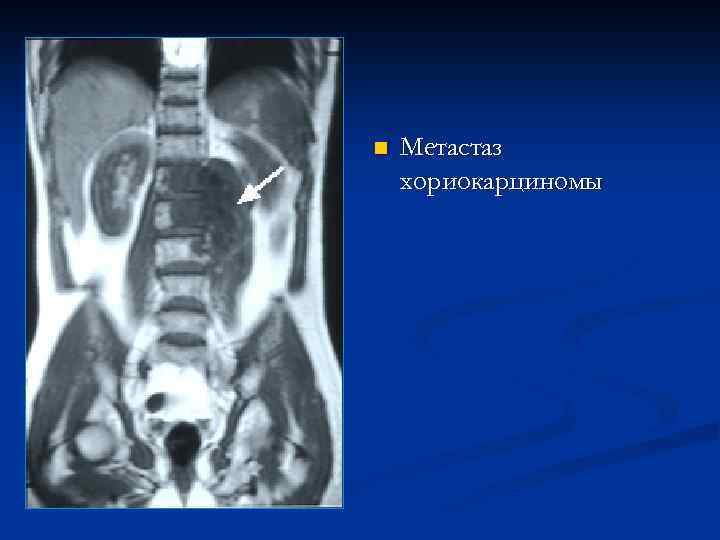n Метастаз хориокарциномы 