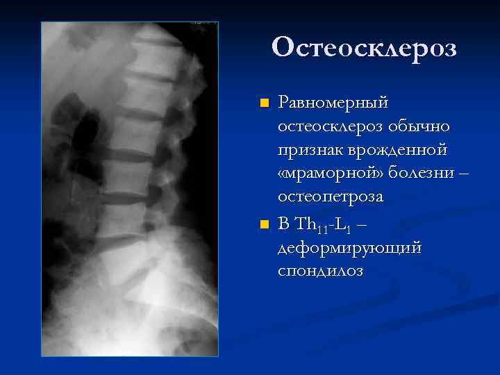 Остеосклероз n n Равномерный остеосклероз обычно признак врожденной «мраморной» болезни – остеопетроза В Th