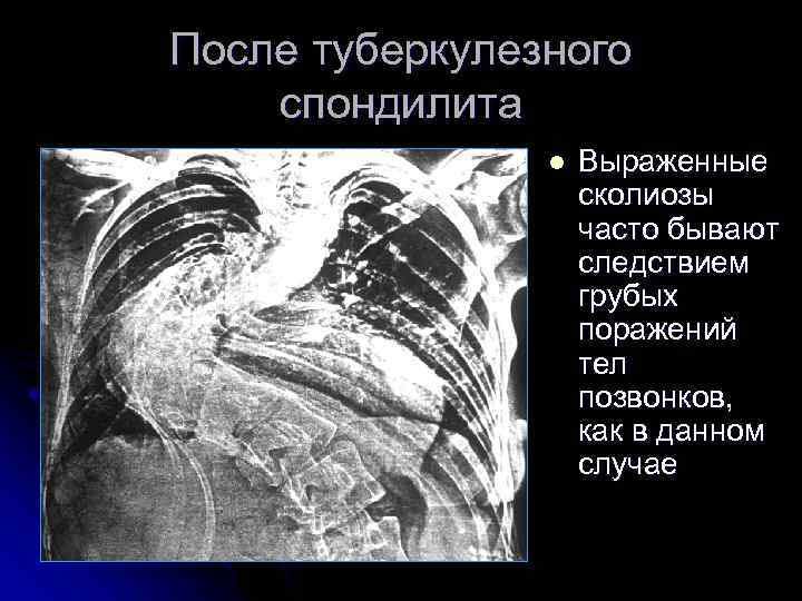 После туберкулезного спондилита l Выраженные сколиозы часто бывают следствием грубых поражений тел позвонков, как