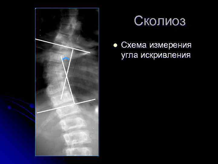 Сколиоз l Схема измерения угла искривления 