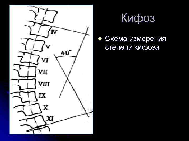 Кифоз l Схема измерения степени кифоза 