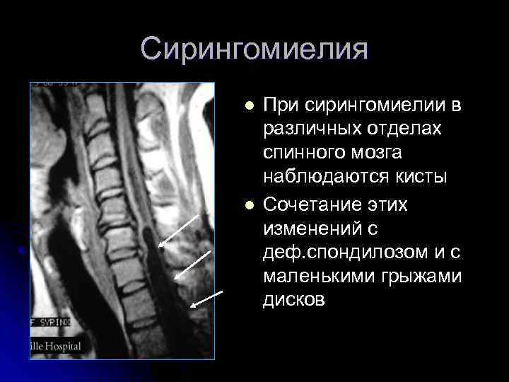Сирингомиелия l l При сирингомиелии в различных отделах спинного мозга наблюдаются кисты Сочетание этих