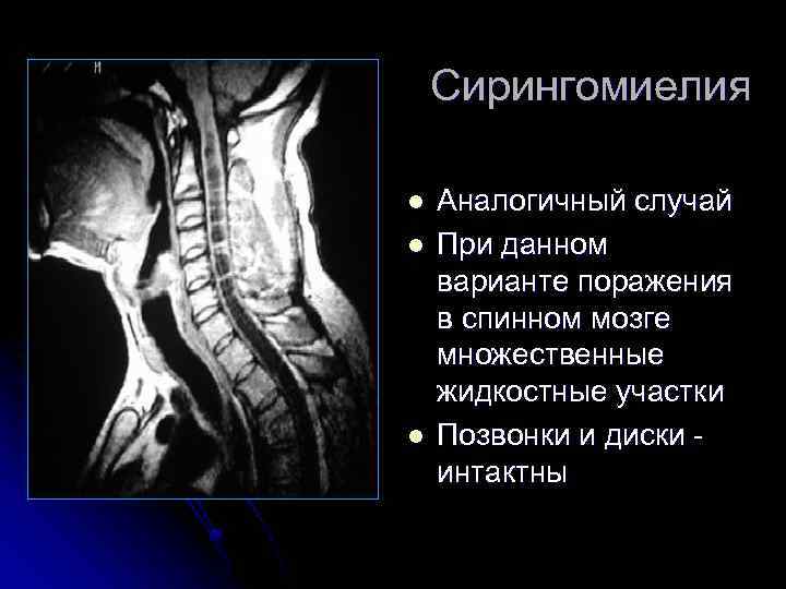 Сирингомиелия l l l Аналогичный случай При данном варианте поражения в спинном мозге множественные