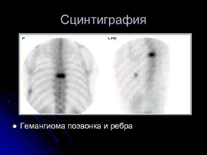 Сцинтиграфия l Гемангиома позвонка и ребра 
